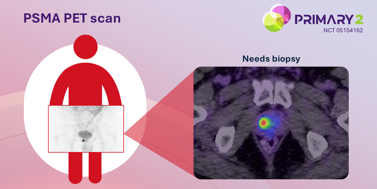 PSMA PET Scan Slide2
